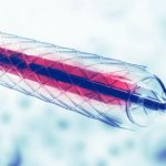 Medical catheter assembly